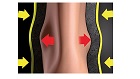 VACU-PLAST CUFF & SHELL